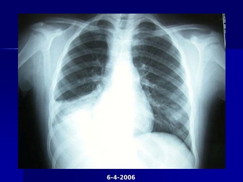 co6. bronquiectasias de etiologÃ­a infrecuente.