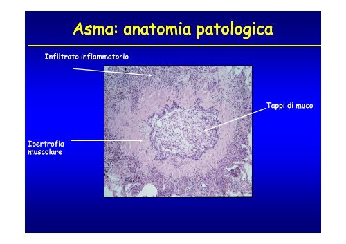 Asma bronchiale.pdf - Clinica malattie apparato respiratorio