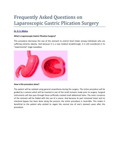 Gastric Plication - World Laparoscopy Hospital