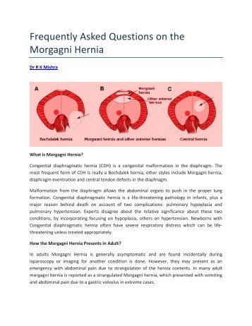 Frequently Asked Questions on the Morgagni Hernia - World ...