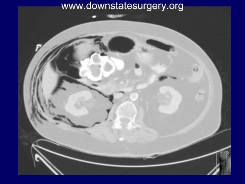 Iatrogenic Duodenal Injuries - Department of Surgery at SUNY ...