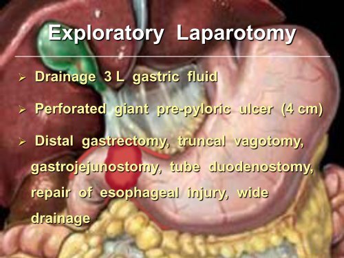 COMPONENT SEPARATION - Department of Surgery at SUNY ...