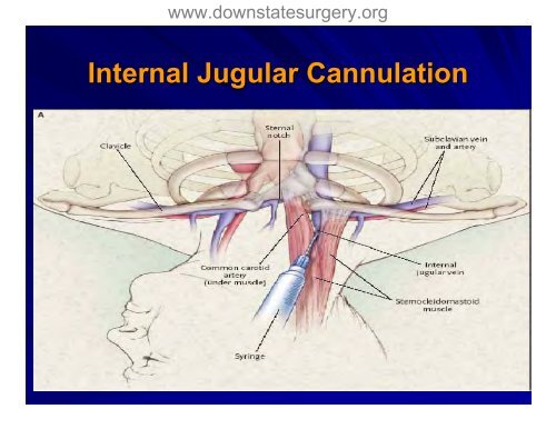 Complications of Central Venous Catheterization - Department of ...