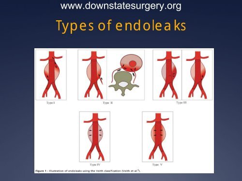 Management of AAA Endoleaks