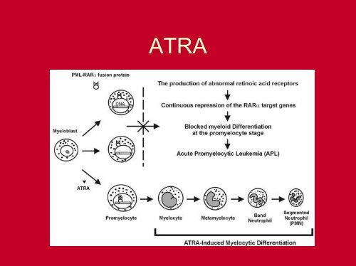 LEUCEMIA PROMIELOCÃTICA AGUDA