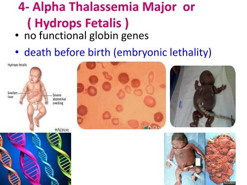 Beta Thalassemia