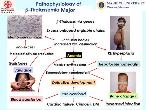 Beta Thalassemia