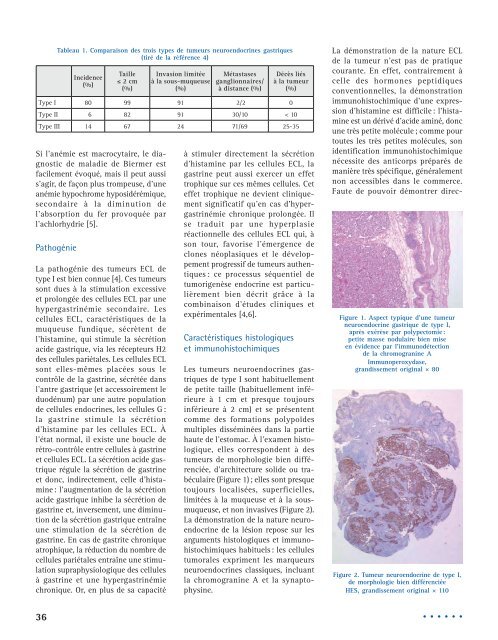 Les tumeurs neuroendocrines gastriques