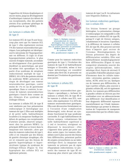 Les tumeurs neuroendocrines gastriques