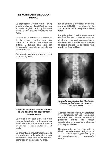 Riñon Medular en Esponja