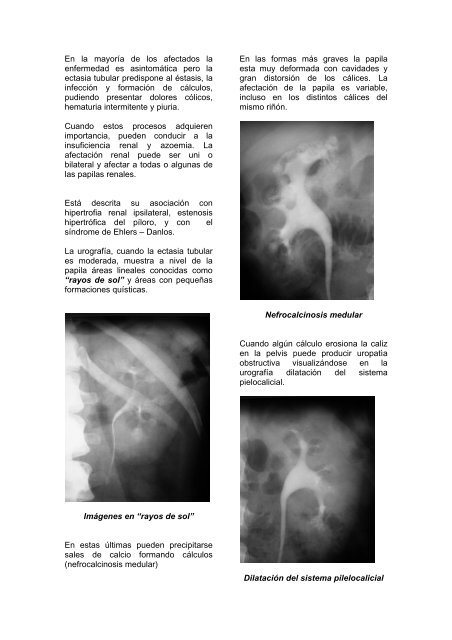 Riñon Medular en Esponja