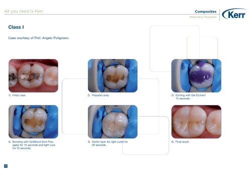 Restorative Procedure - Kerr Hawe