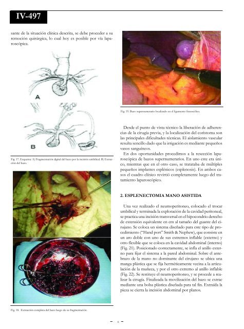 EsplenectomÃ­a. - sacd.org.ar