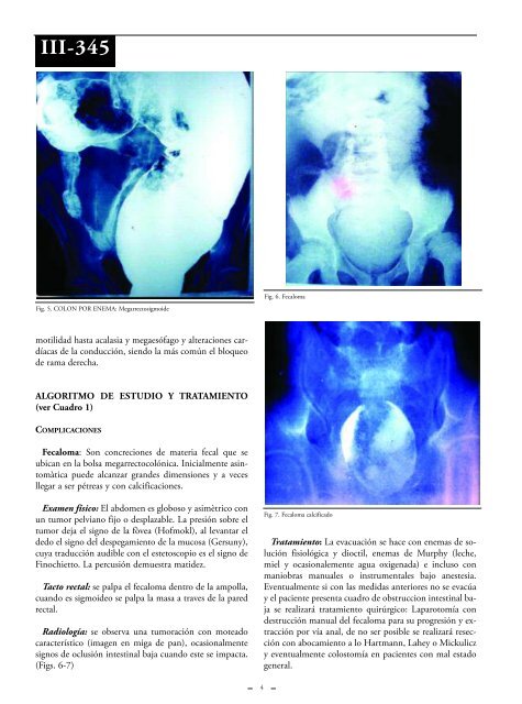 Megacolon. - sacd.org.ar