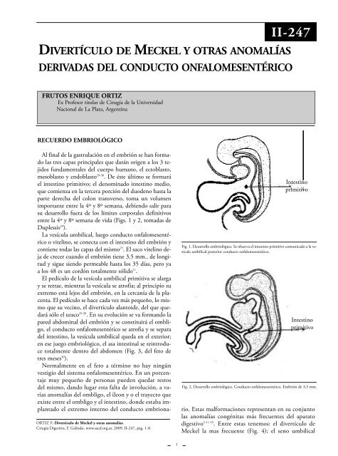 DivertÃ­culo de Meckel y otras anomalÃ­as dereivadas del ... - sacd.org.ar