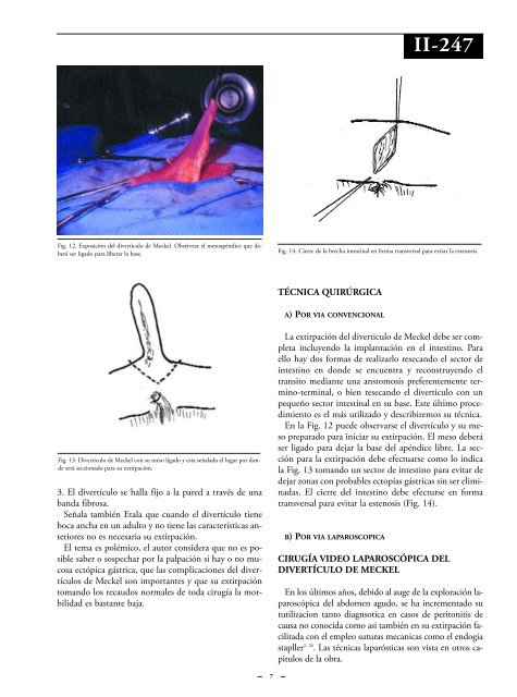 DivertÃ­culo de Meckel y otras anomalÃ­as dereivadas del ... - sacd.org.ar