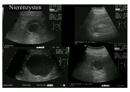 Sonographie der Niere Sonographie der Niere Sonographie der Niere