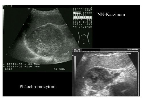 Sonographie der Niere Sonographie der Niere Sonographie der Niere