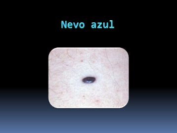 Precursores De melanoma