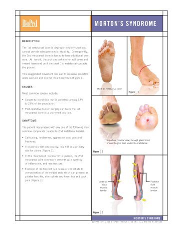 MORTON'S SYNDROME - Mydoctor.ca