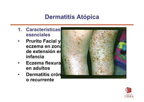 CRITERIOS DIAGNOSTICOS EN DERMATITIS ATOPICA