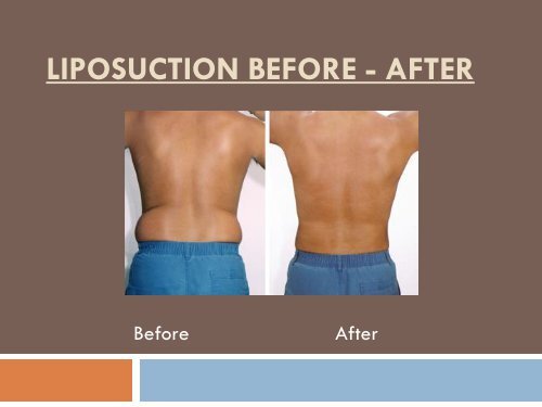 Best Liposuction Surgery In Delhi