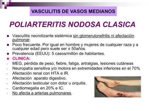 Vasculitis - hgucr
