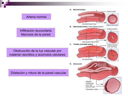 Vasculitis - hgucr