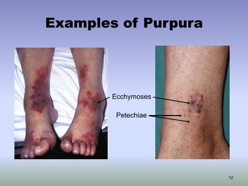 Petechiae, Purpura and Vasculitis