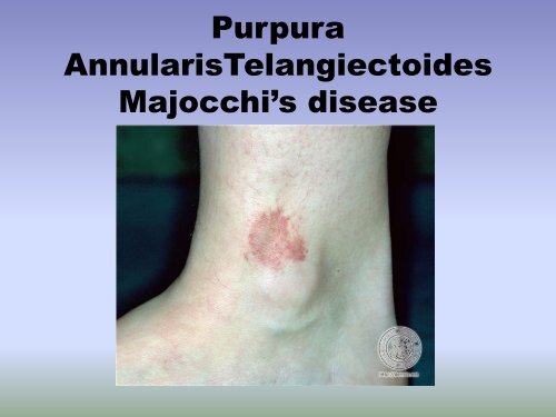 Petechiae, Purpura and Vasculitis