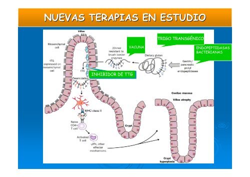 Enfermedad celÃ­aca.pdf