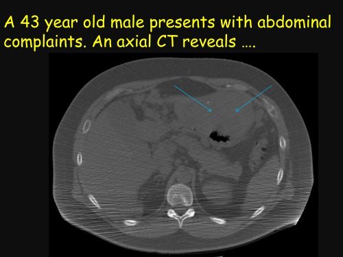 GIST Pathology PowerPoint by Dr. Rosenberg - The Life Raft Group