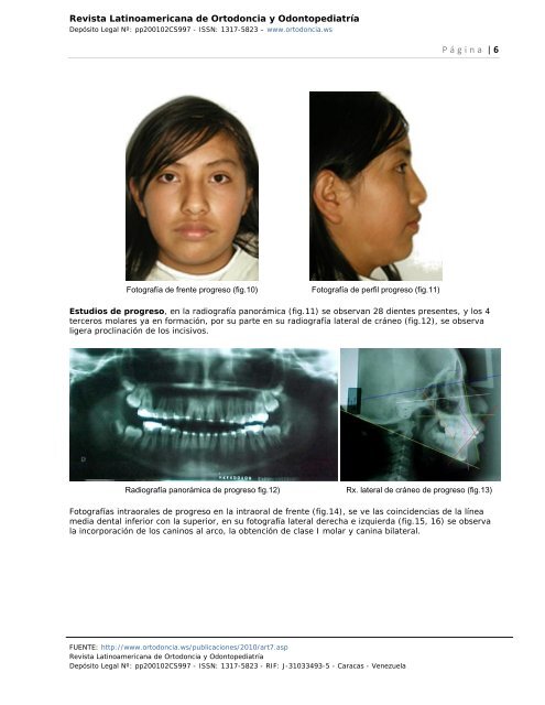 MANEJO DE ESPACIO DE LEEWAY EN DENTICIÃN MIXTA ...