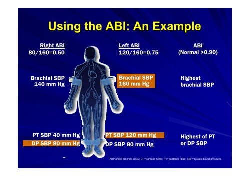 Diabetes & Peripheral Arterial Disease: