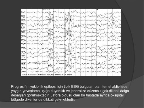 cocukluk donemi paroksismal hastaliklar.pdf