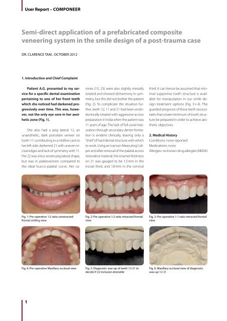 Semi-direct application of a prefabricated composite veneering ...