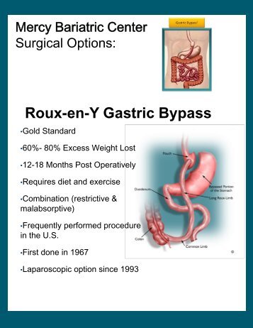 Roux-en-Y Gastric Bypass - Mercy