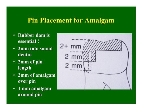 Pin Placement for Amalgam