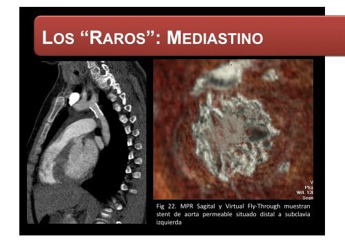 LOS “RAROS”: PARTES BLANDAS