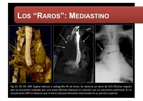 LOS “RAROS”: PARTES BLANDAS