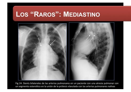 LOS “RAROS”: PARTES BLANDAS