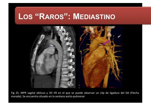 LOS “RAROS”: PARTES BLANDAS