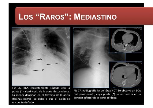 LOS “RAROS”: PARTES BLANDAS