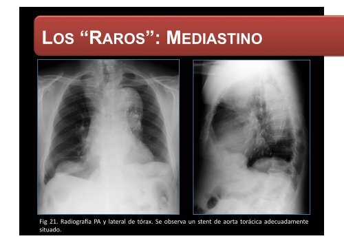 LOS “RAROS”: PARTES BLANDAS