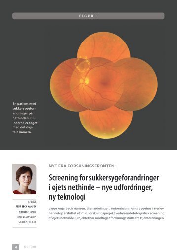 Screening for sukkersygeforandringer i øjets nethinde – nye ...