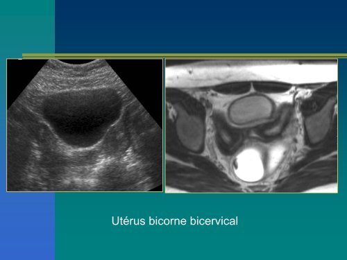 ECHOGRAPHIE ET INFERTILITE FEMININE ECHOGRAPHIE ET ...