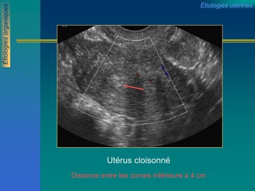 ECHOGRAPHIE ET INFERTILITE FEMININE ECHOGRAPHIE ET ...