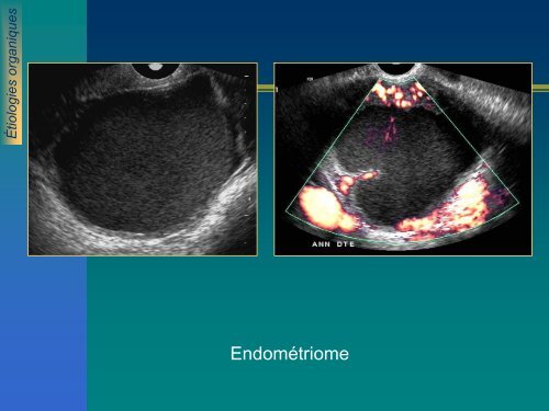 ECHOGRAPHIE ET INFERTILITE FEMININE ECHOGRAPHIE ET ...