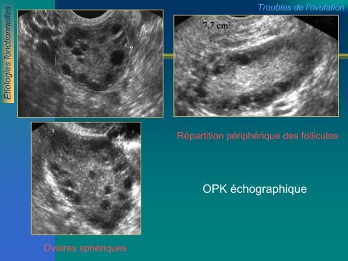 ECHOGRAPHIE ET INFERTILITE FEMININE ECHOGRAPHIE ET ...