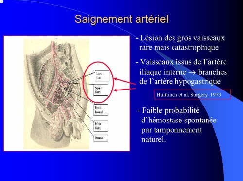 Prise en charge des traumatismes du bassin sévères